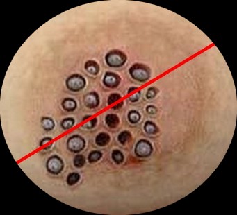 2016-infection du sein par un papillomavirus humains (HPV)-01--